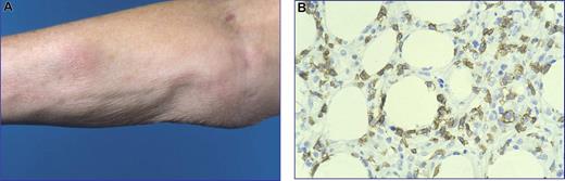 Figure 1. Subcutaneous panniculitis-like T-cell lymphoma with an α/β T-cell phenotype (SPTL-AB). (A) Nodular skin lesion next to an area of lipoatrophy occurring after disappearance of the skin lesions. (B) Subcutaneous infiltrate with rimming of CD8+ neoplastic T cells around adipocytes (original magnification, ×480). The image in panel B was obtained through a Leica DM600B microscope (Leica, Rijswijk, the Netherlands). Image acquisition was performed with a ProgResC10 camera and software (JenaOptik, Jena, Germany). An HC Plan APO 40×/0.85 objective was used.