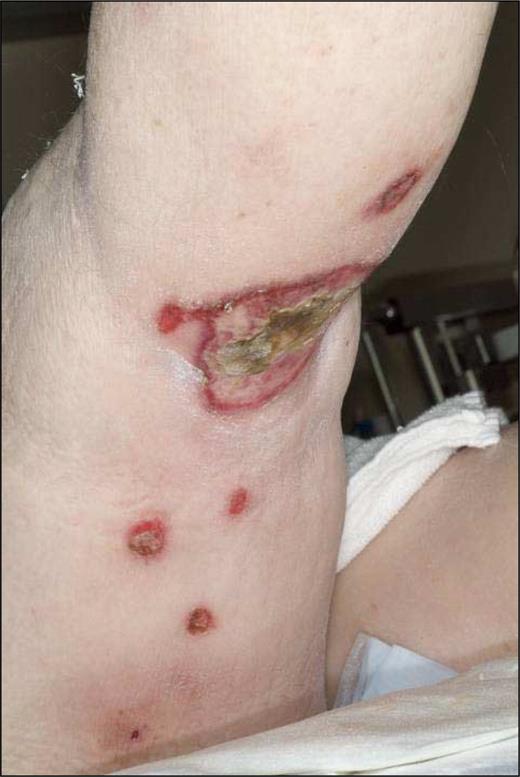 Figure 3. Subcutaneous panniculitis-like T-cell lymphoma with a γ/δ T-cell phenotype (SPTL-GD). Nodular and ulcerating skin lesions.