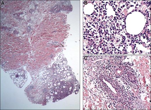 Figure 4. Subcutaneous panniculitis-like T-cell lymphoma with a γ/δ T-cell phenotype (SPTL-GD). (A) Low-power view showing subcutaneous infiltrates, as in SPTL-AB with the addition of perivascular infiltrates in the dermis (H&E staining; original magnification, ×25); (B,C) details of subcutaneous infiltrate showing rimming of fat cells by neoplastic T cells (B), and dermal infiltrates showing angioinvasion (C). Image acquisition obtained as described in Figure 1. An HC FLUOTAR 2.5/0.07 objective was used for panel A; an HC Plan APO objective was used for panels B,C (40×/0.85 for B; 20×/0.70 for C).