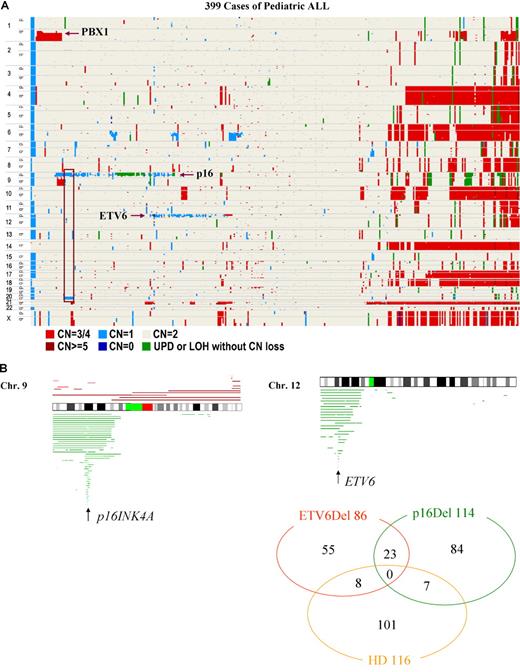 Figure 2. Allelokaryotyping of pediatric ALL. (A) Genetic clustering of 393 ALL samples. Genetic status of each chromosomal region is visualized. Vertical axis: chromosomes, p: short arms, q: long arms. Horizontal axis: individual cases. CN: copy number of alleles. UPD: uniparental disomy. Locations of PBX1, INK4A/ARF(p16), and ETV6 genes are indicated. A rectangle indicates cases having 9p and 20q deletions. (B) Three common genomic abnormalities detected in ALL by SNP-chip analysis. Left panel: Deletion of 9p is frequently detected; the arrow indicates the commonly deleted region (CDR) where the p16INK4A gene is located. Right panel: Deletion of 12p often occurs. The arrow indicates that the CDR is where the ETV6 gene is localized. Green lines under the chromosome indicate the deleted regions in individual cases. Brown lines above the chromosome indicate the duplicated regions. Only representative cases are shown. Green and red bands on idiograms indicate centromeres and noncoding regions, respectively. Bottom panel: Venue diagram of 3 common abnormalities detected in this study. Numbers of respective cases in each category are indicated. HD: ALL with hyperdiploid (chromosomes > 50). ETV6Del: ALL with deletion of ETV6 gene. p16Del: ALL with deletion of p16INK4A gene.