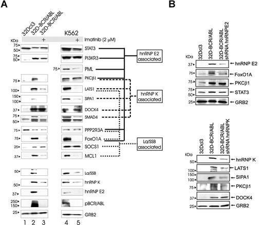 Figure 3. Expression analysis of the hnRNP-K–, hnRNP-E2–, and La/SSB-associated mRNA products in BCR/ABL+ cells.(A) Western blots show levels of the candidate hnRNP-E2–, hnRNP-K–, and La/SSB-associated mRNA products in 32Dcl3 (lane 1) and in untreated and imatinib-treated 32D-BCR/ABL (lanes 2,3) and K562 (lanes 3,5) cells. Levels of La/SSB, hnRNP-E2, hnRNP-K, BCR/ABL (antiphosphotyrosine), and GRB2 were detected as controls. (B) Western blots show expression of hnRNP-E2, FOXO1A, PKC1β, and STAT3, and of hnRNP-K, LATS1, SIPA1, PKCb1, and DOCK4 in hnRNP-E2 (top panel) shRNA- and (bottom panel) hnRNP-K shRNA–transduced 32D-BCR/ABL, respectively. Expression in parental and BCR/ABL-expressing 32Dcl3 cells served as controls.