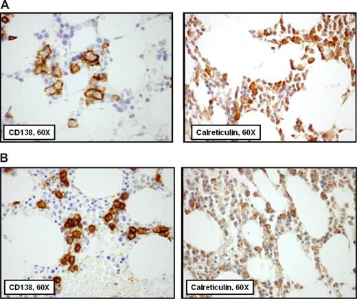 Figure 3. Calreticulin expression is variable in the plasma cells of patients with systemic AL-amyloidosis by immunohistochemical staining of bone marrow biopsies. In these images from adjacent sections of bone marrow biopsies from 2 patients, CD138+ plasma cells stained immunohistochemically are shown on the left and calreticulin on the right. A pathologist who did not know the clinical status of the patients scored all cases blindly for intensity and distribution of calreticulin to compute the calreticulin index. In panel A, the calreticulin index of 9 is a function of the intensity of staining, indicating that calreticulin was found in a pancytoplasmic distribution. In panel B, the calreticulin index of 3 is a function of an intensity score of 1, indicating that the distribution of calreticulin was rare and scattered.