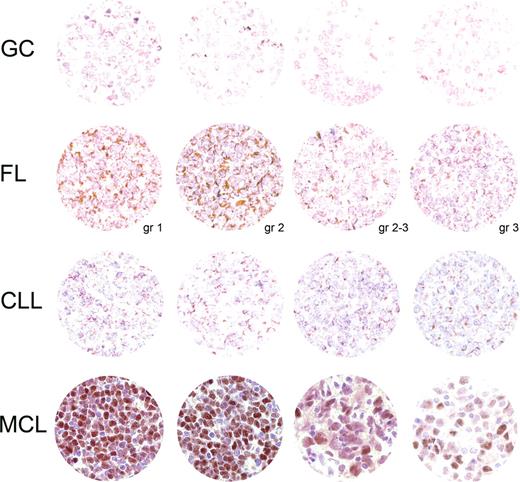 Figure 2. Sox11 IHC analysis. A TMA montage of representative Sox11 IHC signals in each category tested includes rows of benign tonsillar germinal centers (GCs), follicular lymphoma (FL, with tumor grade at the bottom right), chronic lymphatic leukemia/small lymphocytic lymphoma (CLL), and mantle cell lymphoma (including blastoid variant in the third image from the left). Each section in the first 3 rows displays granular cytoplasmic staining. A single positive nucleus in the second FL section is probably endothelial. In contrast, most MCL nuclei express Sox11 with varying intensity. Hematoxylin counterstain; magnification, 185×.