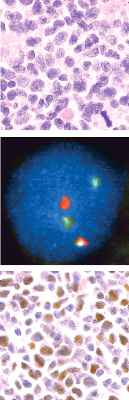 Figure 3. CCND1− MCL. The top panel displays a lymphoma histologically consistent with MCL (H&E stain). The diagnosis was confirmed by FISH, which in the middle panel shows probe hybridization to IGH (green) and CCND1 (red) loci in a nucleus with a single yellow fusion signal. In the bottom panel, tumor nuclei strongly express Sox11.