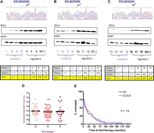 Figure 1. Lack of correlation of BCL2 SNP −938A>C with either BCL2 protein or mRNA levels in CLL. (A-C) Comparison of levels of BCL2 expression with −938A>C SNP. All 3 genotypes showed both low and high levels of BCL2 protein. β-actin was used as a standard for normalization of BCL2 expression, and then all samples were compared with levels observed in the cell line SC-1. For QRT-PCR, the samples were normalized to SC-1 RNA. The values represent the ratios of ΔΔCT SC-1 cell line to ΔΔCT patient RNA. Note that many of the patients with CLL with low BCL2 expression nevertheless expressed large amounts of BCL2 RNA. Arrows in top panels denote SNP −938C>A. (D) Range of levels of expression of BCL2 protein in 100 patients with CLL according to BCL2 promoter SNP −938 A>C. Horizontal bar denotes mean value for each group. There was no significant change in the levels of BCL2 protein expression with the SNP genotype. (E) Time to first treatment in the 98 patients from this cohort treated to date according to the BCL2 promoter SNP −938 A>C, showing lack of influence of the SNP in this series.