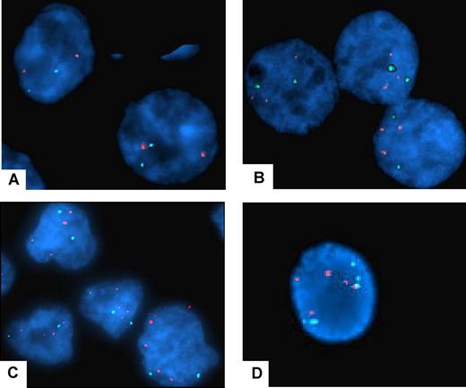 Figure 4. Fluorescent in situ hybridization with centromer and PRL-3 probe on MM cell lines and CRO-AP5. The results of FISH analysis with PRL-3 probe (SpectrumOrange) and centromer probe (SpectrumAqua). The red signals mark PRL-3 (8q24.3) and the aqua marks the centromer on chromosome 8. The cell nucleus is stained with DAPI. Original magnification is ×1000. (A) The OH-2 cell line has a normal chromosome 8 with 2 centromer signals and 2 PRL-3 signals. (B) The RPMI-8226 cell line has 2 centromer signals and 3 PRL-3 signals. (C) The CRO-AP5 cell line has 2 centromer signals and 4 to 5 PRL-3 signals, indicating that the area where the PRL-3 gene is located is amplified. (D) The IH-1 cell line has 5 PRL-3 signals and 5 centromer signals, demonstrating polyploidy of chromosome 8.