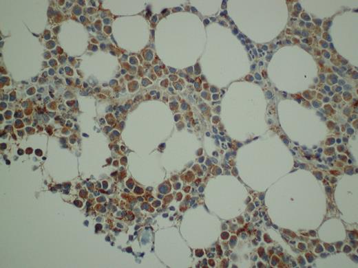 Figure 5. Expression of PRL-3 in malignant PCs from myeloma patients evaluated by immunohistochemistry. We stained BM biopsies from 20 patients, and found that 18 patients were PRL-3–positive to different degrees. In 11 of the biopsies more than 50% of the PCs were stained. A representative biopsy is illustrated. Original magnification ×400.