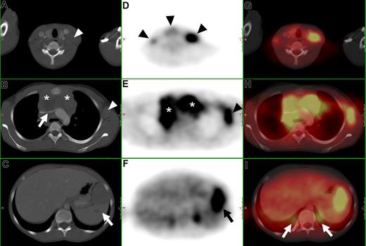 Figure 1. CT, FDG-PET, and FDG-PET/CT fusion of a 13-year-old female with Hodgkin disease. (A-C) Axial CT images show (A) a cervical lymph node mass (), (B) a large mediastinal mass (*) compressing the left brachiocephalic vein (), an enlarged axillary lymph node (), and (C) an enlarged inhomogeneous spleen (419). (D-F) Axial PET images show pathologic FDG uptake in (D) cervical lymph nodes (), (E) in the mediastinum (*), in a left axillary lymph node mass (), and (F) in the spleen (). (G-I) Fused PET/CT images. (I) Note the misregistration of normal renal FDG excretion ().