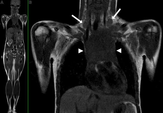 Figure 2. WB-MRI of a 16-year-old female with Hodgkin disease. (A) Coronal T1-weighted WB-MRI. (B) Close-up image shows bilateral enlarged cervical lymph nodes (arrows) and a large mediastinal mass (arrowheads) consistent with confluent lymphadenopathy.