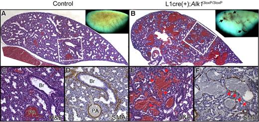 Figure 6. Alk1 deletion resulted in abnormal pulmonary vasculature in E17.5 L1cre(+);Alk13loxP/3loxP fetuses. Transverse sections of the left lobe of the control (A,C,D) and mutant (B,E,F) lungs. Blood vessels are readily identifiable by the red blood cells in them. Dissection microscopic views of the left lung are shown as insets. The control lung displayed organized vascular trees (A, inset), whereas the mutant lung exhibited dilated, tortuous, and irregular blood vessels (B, inset, arrows). In the control lungs (A,C), bronchial trees and blood vessels are coordinated, and blood vessels are well defined as a circular shape. Br indicates bronchus; PA, pulmonary artery; and H&E, hematoxylin and eosin. In the mutant lungs (B,E), the bronchial lumens are not expanded as much as control lungs, and blood vessels are noticeably enlarged and irregular, presumably resulting from fusions between neighboring vessels (arrowheads in E). (D,F) Immunostaining with anti-αSMA antibodies revealed thinning of blood vessel walls with irregular thickness of smooth muscle layers (arrowheads in F).