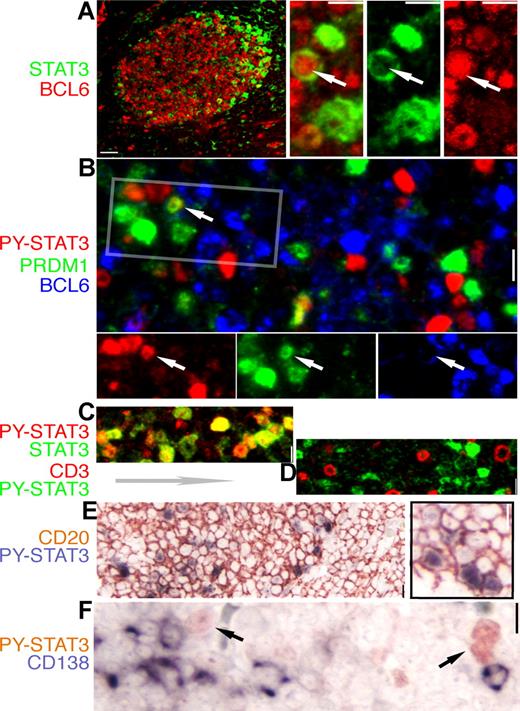 Figure 3. Expression of STAT3 and BCL6 are mutually exclusive in normal GC cells. IHC and IF staining of normal tonsil GC for STAT3 and lineage- and differentiation-associated markers. The color for each marker is depicted by the label beside each panel. (A) A low-power image of BCL6 (red) and STAT3 (green) staining; note the STAT3+ cell localizing to the apical light zone. The high-power insets on the right are from an enlarged apical light zone area showing a rare cell (arrow) with nuclear BCL6 and cytoplasmic STAT3, whereas the other STAT3+ cells have no BCL6. (B) Triple staining for BCL6, PRDM1/Blimp-1, and PY-STAT3 shows mutually exclusive nuclear PY-STAT3 and BCL6, as well as PY-STAT3 and PRDM1. Rare double STAT3+PRDM1+ cells are noted (arrow). The rectangle is selected, and the image is split into a single-color panel below. (C) Double staining for STAT3 and PY-STAT3 shows that these 2 signals are always colocalized (shades of yellow color). (D) Double staining for PY-STAT3 and CD3, a pan-T marker, shows that there is no overlap between these 2 markers. (E) Double staining shows that all STAT3+cells are positive for CD20, a pan-B marker. (F) Double staining for PY-STAT3 and CD138/Syndecan, a late-stage plasma cell marker, shows that these 2 markers are mutually exclusive. Scale bar, 4 μm in the low-power image of panel A, 1 μm in other panels.