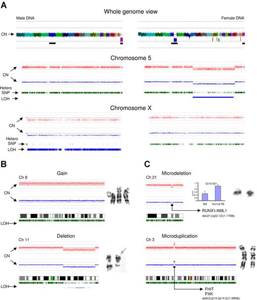 Figure 1. Analysis approach and type of lesions detected by SNP-A. (A) Normal male (left portion) and abnormal female karyotype with multiple lesions, including del(5q) (right portion). Whole genome scan is shown (top panel); each color represents copy number of a different chromosome (chromosome Y is not included on the array). Chromosome 5 is presented (middle panel) for both patients. Red dots depict single SNP signal intensity, while blue lines present an average value of SNP signal intensity. Green vertical bars represent heterozygous SNP loci, while blue bars show areas of LOH. In comparison to the normal chromosome 5 (left portion), the deletion 5q can be easily observed as a reduction in copy number and area of homozygous SNP loci (right portion). Idiogram of chromosome X is shown (bottom panel) demonstrating the haploid copy number with homozygous SNP loci (male DNA, left portion) and diploid DNA copy number with characteristic distribution of heterozygous SNP loci (female DNA, right portion). MC-detected chromosomal abnormalities (karyograms included) confirmed by SNP-A (B). (C) SNP-A–detected microdeletion of chromosome 21 and microduplication of chromosome 3. Copy number confirmation using Taq-Man Real-Time PCR shown as blue bars and compared with normal T cells (CD3+) obtained from the same patient. Microsatellite ID marker is displayed above the bars. Y axis (2−ΔΔCt) presents the relative quantification scale, where 1 equals diploid DNA copy number. Examples of deleted and duplicated genes are included. Error bars represent SD.
