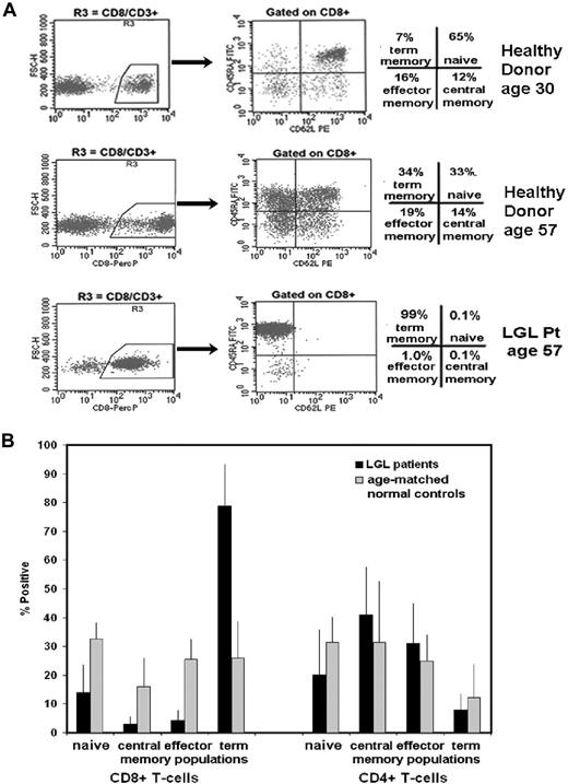 Figure 1. Naive and memory phenotyp13.6pe distribution in CD8+ and CD4+ T cells from patients with LGL leukemia compared with healthy control subjects using coexpression patterns of CD45RA and CD62L. (A) Flow cytometry was performed on cells stained with CD3, CD8, CD62L, and CD45RA. A gate was set on CD3+ cells and a second gate set on CD8+ (R3) and CD8− (CD4+) T cells. CD62L (x-axis) and CD45RA (y- axis) were used to distinguish specific T-cell subsets that included naive (top right quadrant), central memory (bottom right quadrant), effector memory (bottom left quadrant), and terminal-effector memory (top left quadrant) T cells. Representative results from healthy donors aged 30 and 57 years and a patient with LGL leukemia aged 57 years are shown. (B) Graphic representation of the mean percentage positive of these 4 distinct T-cell subsets in patients with LGL leukemia (n = 6) compared with age-matched healthy control subjects (n = 6). Standard deviation (SD) is indicated, and statistical significance was determined by a Wilcoxon sum rank test.