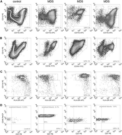 Figure 1. Examples of flow cytometric differentiation patterns for granulocytes and monocytes and lineage infidelity marker expression on myeloid progenitor cells. (A) The relationship between CD11b (x-axis) and CD13 (y-axis) during granulocyte maturation in 1 normal control (left graph) and 3 MDS samples; UPNs correspond to Table 3. Granulocytes were selected by CD45 expression and intermediate to high SSC. A white arrow in the panel of the control sample on the left indicates the development of granulocytes from immature to mature forms. Graphs of patients with MDS demonstrate abnormal maturation or aberrant antigen expression compared with the control sample. (B) The relationship between CD16 (x-axis) and CD13 (y-axis) for granulocytes. Development from immature to mature granulocytes is illustrated by a sickle-shaped white arrow in the graph of the control sample. Graphs of patients with MDS show aberrant antigen expression and maturation compared with the normal control. (C) The relationship between HLA-DR (x-axis) and CD11b (y-axis) during monocyte maturation. Monocytic cells were selected by SSC, CD45, and CD14 expression. A white arrow in the control sample depicts normal maturation of immature blasts toward maturing monocytes. The monocytic subpopulation in the MDS samples either lack expression of HLA-DR or show overexpression of this antigen or overexpression of CD11b. (D) Expression of CD7 (x-axis) on myeloid progenitors, defined by CD45dimSSClow/int and CD34 expression, is depicted. Percentages of myeloid blasts and percentages of CD7+ blasts are indicated in the graphs.