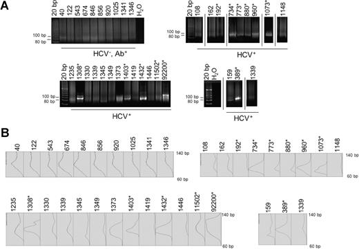 Figure 1. Ig CDR3 PCR. DNA was isolated from PBMCs, amplified following an established protocol (see “CDR3 PCR”) and run on a 12% polyacrylamide gel. Polyclonal CDR3s are indicated by the presence of DNA smears between 80 and 120 bp, the expected size range of CDR3. Monoclonal and oliglonal CDR3s are reflected by the presence of solitary, or 2 to 3 bands, respectively, in the expected size range (A). Densitometric analysis of gel bands (B). *Patients with MC.