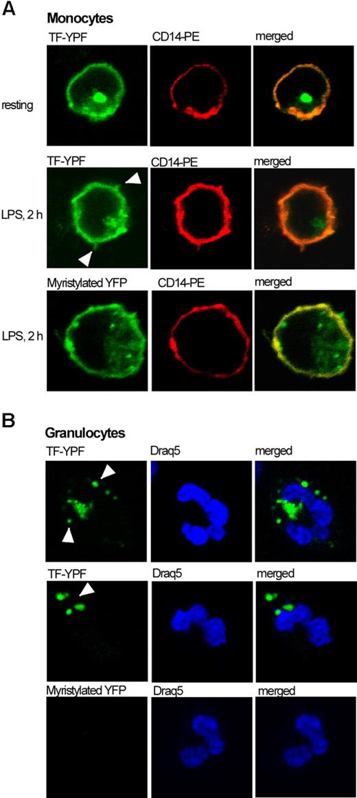 Figure 6. Intracellular distribution of TF-YFP fusion protein in monocytes and granulocytes. TF-YFP is evenly distributed throughout the membrane of nonstimulated monocytes and is also accumulated in the cytoplasm as a single speckle (panel A top). LPS stimulation enriches TF-YFP localization onto the monocyte membrane, which extends the protrusions (panel A middle). Myristylated YFP localized in the plasma membrane on monocytes (panel A bottom). TF-YFP fusion protein, acquired by granulocytes, localizes within cytoplasmic speckles (panel B top, middle). Granulocytes did not acquire myristylated YFP (panel B bottom). Draq5 indicates DNA fluorescent marker.