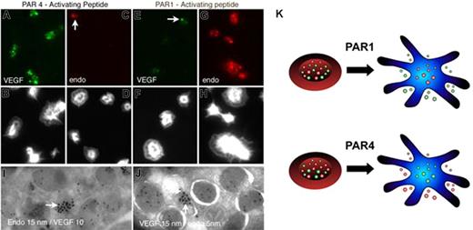 Figure 4. Activation of specific protease activated receptors stimulates the selective release of α-granules containing either endostatin or VEGF. Platelets were treated with platelet buffer in the presence of agonists for 10 minutes with PAR4-activating peptide (A-D), and PAR1-activating peptide (E-H) and then fixed and processed for immunofluorescence microscopy. Cells were stained with either anti-VEGF antibodies (Alexa 488 green labeling; A,E) or antiendostatin antibodies (Alexa 568 red labeling; C,G,) to assay for granule retention or release. All micrographs were taken at the same exposure time. Corresponding staining with Alexa-phalloidin (B,D,F,H) in the bottom panels highlights the morphology of the platelets. Negative controls consisting of incubation with both secondary fluorescently labeled antibodies only or incubation with only primary antibodies failed to show appreciable fluorescence (data not shown). Images are representative of at least 10 high-power fields for each experiment, and each experiment was performed 3 times. Representative images of immunoelectron microscopy of platelets treated with either PAR4-AP (I) or PAR1-AP (J). Double immunogold labeling on platelet sections was performed with the use of anti-VEGF antibody and antiendostatin antibodies. In the PAR4-treated samples (I), large gold particles representing antiendostatin staining (15 nm) are evident on one α-granule (arrow) and small gold particles (5 nm) representing VEGF staining are abundantly present on separate population of multiple α-granules. In the PAR1-treated samples (J), large gold particles representing anti-VEGF staining (15 nm, arrow) are evident on one α-granule (arrow) and small gold particles (5 nm) representing endostatin staining are abundantly present on separate population of multiple α-granules. (K) A model illustrating the mechanism of differential granule release from platelets. A simplified summary of the pathway is shown. Resting platelets contain both proangiogenic (green) and antiangiogenic (red) granules. Selective activation of the PAR1 receptor causes release of granules containing proangiogenic factors, whereas selective activation of the PAR4 receptor causes release of granules containing antiangiogenic factors.