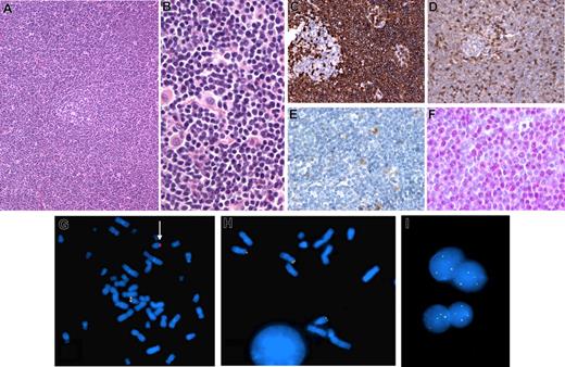 Figure 1. Histologic, immunohistologic, and cytogenetic features in a case of cyclin D1-negative lymphoma with CCND2-IGH fusion. (A,B) Hematoxylin and eosin–stained lymph node biopsy showing a vaguely nodular lymphoid infiltrate around an atrophic residual germinal center (A), composed of small cells with irregular nuclei admixed with scattered histiocytes (B). (C-F) Immunohistochemical findings: strong CD5 expression in the tumor cells around a negative residual germinal center (C); CD43 immunostaining of the lymphoma cells, with a lesser intensity than the reactive T cells (D); lack of cyclin D1 expression in the tumor cells; note that reactive histiocytes exhibit moderate nuclear staining (E); cyclin D2 nuclear expression in the tumor cells detected by a polyclonal anti-cyclin D2 antibody (Cell Signaling) (F). (G-I) FISH results on the bone marrow (G,H) and the lymph node (I) samples. Hybridization of spread metaphases with LSI IGH Dual Color, Break Apart Rearrangement probe (Vysis) shows one chromosome 14 with a normal hybridization pattern (juxtaposed centromeric orange and telomeric green probes) and one chromosome 14 hybridizing only with the centromeric probe, indicating an IGH break (arrow); loss of the telomeric part of the probe precluded identification of the partner chromosome (G). A break apart FISH assay for CCND2 locus rearrangement (telomeric BAC clone: RP11-578L13; centromeric BAC clone: RP11-388F6) shows 2 chromosomes 12 with a normal hybridization pattern and hybridization of the telomeric green probe to 14q, indicating a cryptic t(12;14)(p13:q32) (H). The CCND2 rearrangement is confirmed in the lymph node sample by interphase FISH as the nuclei show 2 yellow (normal chromosomes 12) and one or 2 green (derivative 14) signals with the 2 BAC clones (I). H&E and immunostains images were visualized under a Nikon Eclipse 80i microscope (Nikon, Tokyo, Japan) equipped with Nikon Plan Fluor 10×, 20×/0.50 NA, 40×/ objective lenses and a CFW-1310C camera (Scion, Frederick, MD); images were acquired using Histolab 5.131.1 (Alphelys, Plaisir, France) and processed using Adobe Photoshop v7.0. FISH images were acquired with a 100× immersion objective with an Olympus BX51 fluorescence microscope equipped with the appropriate filter sets, and were documented and processed using the FISH cytovision software.