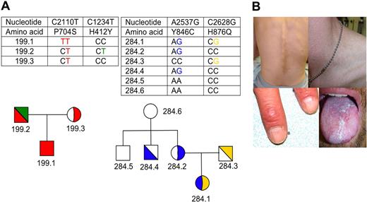 Figure 1. Pedigrees and clinical manifestations in TERT mutations (A) Pedigrees and identified TERT gene mutations in families 199 and 284. Circles, females; squares, males; white, wild type; color, mutant as indicated in the chart. Half-filled symbols indicate heterozygosity. The TERT gene haplotype is shown. (B) Clinical manifestations in patient 199.1. are characteristic of DC, including hyperpigmentation of the back and reticular hyperpigmentation of neck, ridged and brittle fingernails, and leukoplakia of the tongue (Canon EOS 300D).