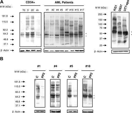 Figure 1. Analysis of the global protein tyrosine phosphorylation in normal HPCs and AML cells. (A) The level of protein tyrosine phosphorylation in normal unstimulated and stimulated (GM-CSF, SCF, and IL-3 for 5 and 20 minutes or for 4 hours) CD34+ HPCs, fresh AML samples, and AML cell lines was studied under similar conditions by Western blot with the antiphosphotyrosine antibody 4G10. The membrane was stripped and reprobed for β-actin as a loading control (lower panel) and for Lyn (black stars). Results shown are representative of experiments performed with normal CD34+ HPCs from 3 healthy donors and 38 AML samples (patient nos. 1, 2, 4–22, 24–28, 30, 31, 33–37, 56–60). (B) A similar analysis was performed on fresh AML cells cultured alone or in the presence of PP2 (10 μM) for 1 hour. Results shown are representative of experiments performed with 20 AML samples (patients 1–20). Black stars indicate the position of Lyn.