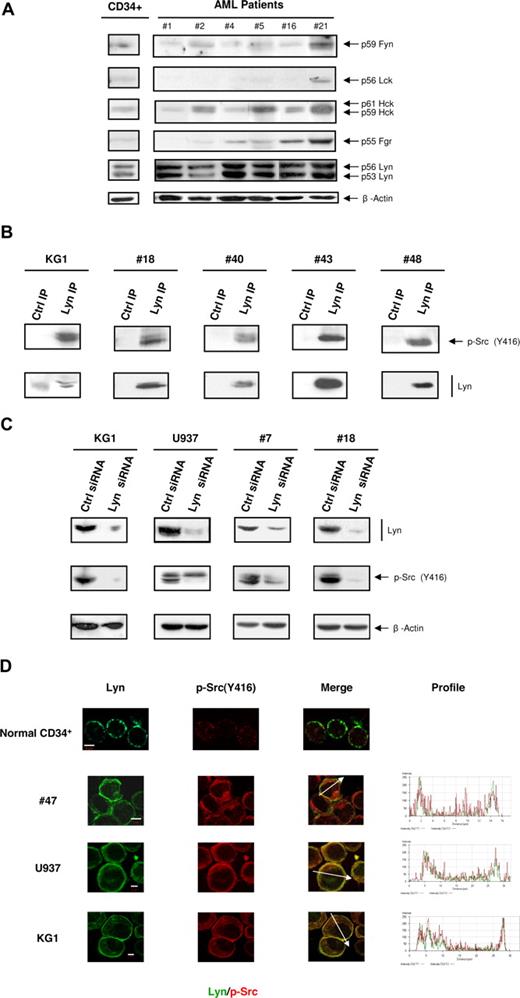Figure 3. Characterization of SFK members in AML cells. (A) The levels of Fyn, Lck, Hck, Fgr, and Lyn from normal CD34+ HPCs and AML samples were analyzed by Western blot using specific antibodies (patient nos. 1, 2, 4–7, 9, 10, 12–16, 18, 19, 21, 22, 24–28, 30, 31, 33–41). The level of β-actin was assessed as loading control (lower panel). Results shown are representative of the different patients analyzed. (B) Protein lysates from KG1 cells and from AML samples (patient nos. 18, 40, 43, 48) were immunoprecipitated using an anti-Lyn antibody. The immunoprecipitates (IP) were probed with anti-pSrc Y416. The membranes were then stripped and reprobed with a biotinylated anti-Lyn antibody revealed with streptavidin-HRP. Control immunoprecipitates were performed with protein A beads only. (C) KG1, U937, and fresh AML samples (patient nos. 7, 15, 18, 45) were cultured after electroporation with Lyn siRNA or control siRNA. The Western blot was performed 48 to 72 hours after electroporation. Results shown are representative of 4 experiments performed with KG1 cells and of the different patients analyzed. (D) Immunolocalization of Lyn and active forms of SFKs was performed by confocal microscopy using specific antibodies in normal CD34+ HPCs and AML samples. Results shown are representative of 3 (for HPC, KG1, and U937) and 8 AML samples (patient nos. 8, 16, 21, 30, 40, 43, 47, 48) independent experiments (original magnification, ×63). Bars represent 5 μm.