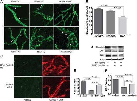 Figure 5. Expression of TJ proteins in HBMECs and microvessels from autopsied brains of seronegative controls and HIV-1–infected humans. (A) All MV samples stained positive for claudin-5. MVs from seronegative control donors (eg, patients N1 and N2) show prominent and continuous strands of tight junction (TJ, arrows); TJ strands in MVs from HIV-1–seropositive patients without HIVE (eg, P1 and P2), and HAD HIVE patients (eg, HAD2 and HAD5) were fewer and had more gaps (arrowheads). Patient HAD5 shows very few TJ strands. (B) Computer-assisted semiquantitative analyses of all MV samples show a significant decrease in claudin-5 expression in MVs from HAD patients, compared with MVs from HIV-1–seropositive patients without HIVE (HIV-POS), or seronegative controls (HIV-NEG). MVs from HIV-1–seropositive patients without HIVE also showed a small (nonstatistically significant) decrease in claudin-5 expression compared with seronegative controls. (C) Double immunostaining of MVs for human CD163 (green) and VWF (red) showed that the isolated MVs did not have macrophage contamination. (D-F) Exposure of HBMECs to HIV-1 (MOI: 0.01) for 24 hours decreased the expression of claudin-5, ZO-1 and ZO-2. Densitometry analysis showed that FLUD significantly diminished HIV-induced down-regulation of claudin-5 (E) and ZO-1 (F). Original magnification of images in panels A and C: ×400.