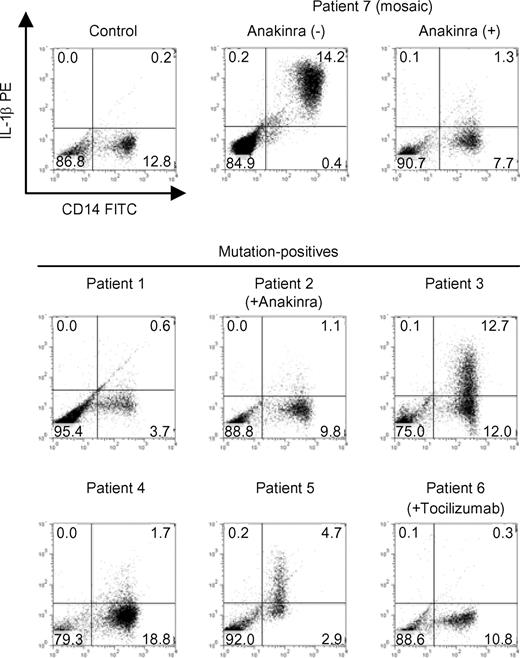 Figure 1. Intracellular IL-1β levels in PBMCs from CAPS patients. PBMCs from healthy controls (n = 10), mutation-positive patients (n = 6), or a mosaic patient (patient 7) were isolated and cultured in vitro for 24 hours. Flow cytometric analysis of CD14 expression and intracellular IL-1β levels was performed. The ratio of CD14+IL-1βhigh monocytes (cells in the right upper quadrant) in healthy controls was 0.26% (± 0.43%; mean ± SD). Data from each of the indicated patients and a representative healthy control are shown. Numbers in each quadrant are the percentages of total cells.
