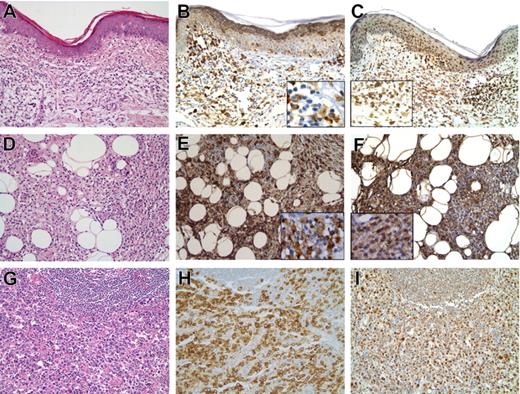 Figure 2. Stage-dependent activation of mTORC1 signaling pathway in tissues involved by CTCL. Representative H&E stains of CTCL patch (A) and tumor (D) stage and lymph node involved by CTCL with large cell transformation (G). Immunohistochemical staining for the phosphorylated S235/236-S6rp (B) and S65-4E-BP1 (C) in the patch stage is negative in the majority of atypical lymphocytes with many of the positive cells representing plasma cells and macrophages (B). The stains are positive for the phospho-S235/236-S6rp and phospho-S65-4E-BP1 in a large subset of the atypical lymphocytes cells at the tumor stage (E and F, respectively). The percentage of positive cells was the highest among the malignant-appearing cells in lymph nodes involved by CTCL that has undergone large cell transformation with the positive cells representing a majority in some cases (H,I). The main images represent 200X magnification ×200 and the insets are magnification ×400.