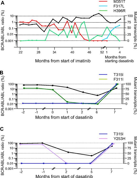 Figure 1. Kinetics of mutations in mutant subclones in 3 representative patients. The kinetics of the BCR-ABL transcripts measured by RQ-PCR are represented by the bold black lines in all 3 panels (expressed as a ratio to the ABL control transcripts × 100%9). The proportions of the subclones with the various mutations measured at different time points are represented by the colored lines. (A) Patient no. 10. A 55-year-old female with CML in chronic phase was started on 400 mg daily IM. After 30 months from start of IM the M351T mutant clone had decreased from 80% to 50%, but an additional mutation, H396R, was identified. Subsequently, the 2 mutations evolved discordantly consistent with 2 distinct subclones. After starting dasatinib only H396R mutation was detectable. One month from start of dasatinib therapy, H396R became undetectable, a third mutant subclone, F317L, was detected by Q-SNP. (B) Patient no. 11. A 53-year-old female achieved a partial cytogenetic response to 400 mg daily IM but despite increasing the dose to 600 mg, she entered myeloblastic transformation. Dasatinib was subsequently introduced at 70 mg twice daily, which induced a reduction in BCR-ABL transcripts over the next 6 months, and the F311I mutation became transiently undetectable by Q-SNP. Subsequently, the BCR-ABL levels increased, and the patient was found to have T315I mutation in addition to F311I. The fact that the levels of the 2 mutations coincided closely in the terminal phase of her disease suggests that they were present in the same allele. This was confirmed by RFLP studies and sequencing of cloned PCR products. The patient eventually died in blastic transformation. (C) Patient no. 12. A 23-year-old woman achieved partial cytogenetic response with IM therapy but failed to maintain the response. She then progressed rapidly to lymphoblastic transformation and underwent sibling allogeneic hematopoietic stem cell transplant (HSCT). Four months after HSCT she relapsed to blastic phase, at which time Y253H mutation was detected. She was then started on dasatinib, which induced a 2-log reduction in BCR-ABL transcript numbers, and the Y253H mutant clone became transiently undetectable. Thereafter tumor load increased and T315I was detected in addition to resurgent Y253H mutation. The Q-SNP data implied both mutations were in the same allele; this was confirmed by RFLP studies.