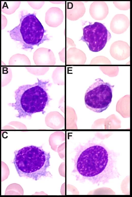 Figure 1. Peripheral blood smear (May-Grünwald Giemsa staining, original magnification ×100). (A-C) Villous lymphocytes in the present series: long and large and broad-based villi unevenly distributed around the cell, round nucleus with clumped chromtin. (D,E) Cells in classical SMZL with short cytoplasmic projections (VLs). (F) Hair cells in HCL.