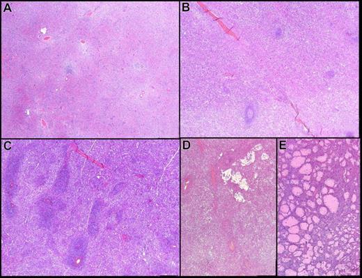 Figure 2. Spleen morphology on paraffin embedded tissue (hematoxylin-eosin safran stain, original magnification ×4). (A) Diffuse infiltration with disappearance of the white pulp–congested sinus. (B,C) Diffuse infiltration with predominant red pulp infiltration and residual atrophic white pulp. (D-E) Large and small blood lakes.
