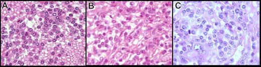 Figure 3. Spleen cytology in paraffin-embedded tissue of the present series (hematoxylin-eosin safran stain, original magnification ×100). The cells observed in the present series on spleen sections showed two distinctive features: (A) cells with round nucleus, clumped chromatin, and abundant basophilic cytoplasm, (B) cells with more irregular nucleus, less clumped chromatin, and less abundant cytoplasm, and (C) an increase in atypical cells with a prominent nucleolus, increase in large cells, and mitosis in morphologically transformed cases.
