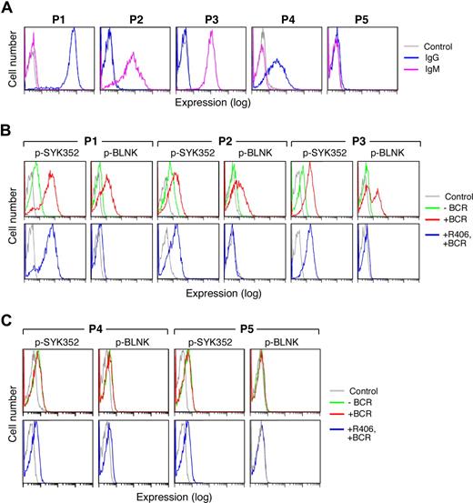 Figure 7. Surface Ig expression and BCR signaling in primary DLBCLs. Cryopreserved tumor cell suspensions were thawed and viable tumor cells were isolated from a Ficoll Hypaque monolayer. Thereafter, the tumor cell suspensions were over 90% viable by Trypan blue staining. Light microscopy, light scatter analysis at flow cytometry, and cell-surface Ig expression confirmed the presence of a predominant population of tumor cells. (A) Cell-surface Ig expression in primary DLBCLs. Cell-surface IgG (blue) and IgM (purple) were evaluated by flow cytometry. P1 expressed high levels of sIgG whereas P2 and P3 expressed sIgM. P4 expressed lower levels of sIgG and P5 lacked surface Ig expression. Cells stained with an isotype-matched control Ig are shown in gray. (B,C) BCR signaling in primary DLBCLs. Single-cell phospho-flow cytometry was used to assess pSYK352 and pBLNK expression in the absence (green) or presence (red) of BCR crosslinking or BCR crosslinking following R406 treatment (blue). Primary DLBCLs with intact BCR signaling (B) and ineffective BCR signaling (C) are shown. Cells stained with isotype-matched control Ig are shown in gray.