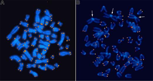 Figure 2. Fluorescence in situ hybridization to detect telomere repeats. Quantitative in situ hybridization (Q-FISH) using Cy3-labeled (CCCTAA)3 peptide nucleic acid probes on metaphase chromosomes from a human lymphocyte (A) and an embryonic fibroblast from a late-generation telomerase RNA KO mouse (B). Note that the fluorescence intensity is very similar for both sister chromatids at individual chromosome ends but very heterogeneous between ends. The arrows in panel B point to pseudo metacentric chromosomes resulting from the fusion of 2 acrocentric mouse chromosomes. Note the lack of telomere repeats at the junction of the 2 fused chromosomes.