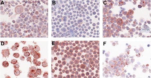 Figure 3. Immunohistochemistry on centrifuge preparations of HL cell lines. Representative photomicrographs of positive immunohistochemistry staining on centrifuge preparations of HL cell lines for 6 proteins: cathepsin C on L1236 (A), CD100 on KMH2 (B), CD150 on L1236 (C), CD63 on L428 (D), CD71 on KMH2 (E), and IL25 on L1236 (F). Photomicrographs were taken using Aperio ScanScope System and were acquired with Digital Slide Information Management Software (Aperio Technologies, Vista, CA). Image layout was subsequently processed by Microsoft Office XP PowerPoint (Microsoft, Seattle, WA; A-F, original magnifications, ×400).