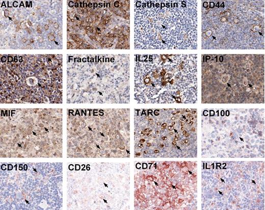 Figure 4. Immunohistochemistry on tissue sections of HL. Representative photomicrographs of positive immunohistochemistry staining on tissue sections for 16 proteins: ALCAM, cathepsin C, cathepsin S, CD44, CD63, fractalkine, IL25, IP-10, MIF, RANTES, and TARC on paraffin-embedded tissues; CD100, CD150, CD26, CD71, and IL1R2 on frozen sections. Photomicrographs were taken using Aperio ScanScope System and were acquired with Digital Slide Information Management Software (Aperio Technologies, Vista, CA). Image layout was subsequently processed by Microsoft Office XP PowerPoint (Microsoft, Seattle, WA; original magnification, ×400). Arrows mark a few of the positive typical HRS cells in all cases.