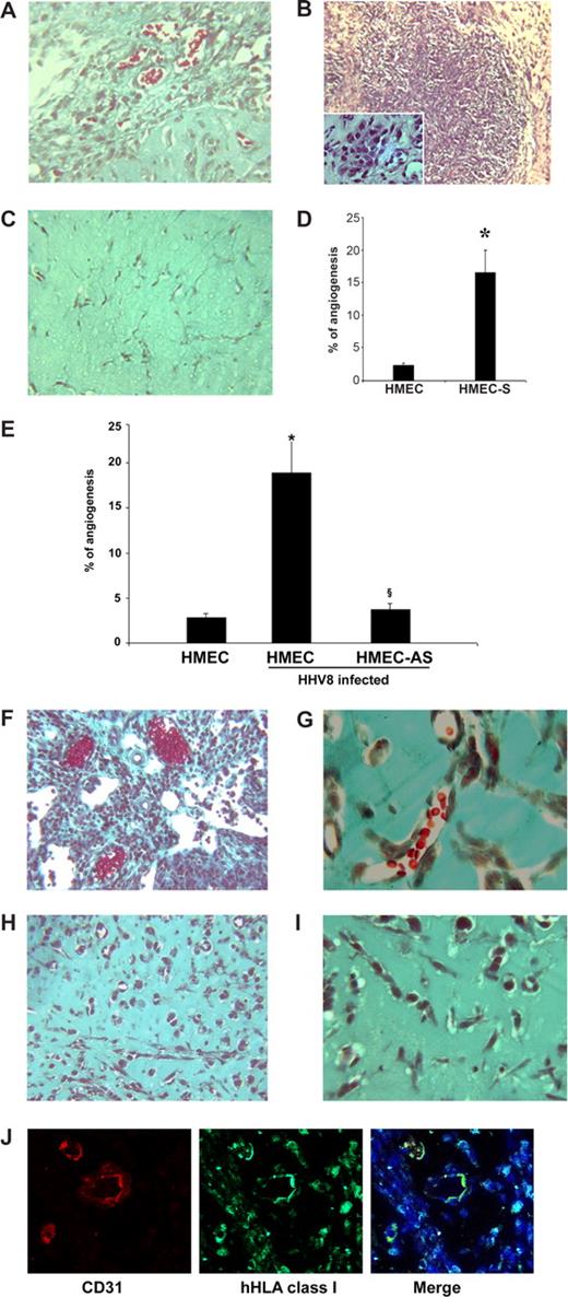 Figure 7. Kaposi-like lesions in SCID mice injected with PAX2-expressing HMECs and in vivo angiogenesis induced by uninfected or HHV-8–infected HMECs and HMEC-AS. (A-D) HMECs (106) transfected with sense cDNA coding for PAX2 and control HMECs transfected with the empty vector were injected in diluted Matrigel subcutaneously in SCID mice. Mice were killed after 6 days, and Matrigel plugs were submitted to histologic analysis. (A-C) Representative micrographs of Matrigel-containing HMEC-S (A,B) and control HMECs (C). HMEC-S showed formation of vessels containing blood erythrocytes (A; Masson trichrome staining) and proliferative lesions (B; hematoxylin/eosin staining). Inset shows the presence of spindle-shaped cells. Angiogenesis and proliferative lesions were absent in control HMECs (C; Masson trichrome staining). (D) Morphometric analysis of new formed vessels within Matrigel. Data are mean plus or minus SD of 5 individual experiments. Mann-Whitney nonparametric test was performed (*P < .05, HMEC-S vs control HMECs). (E-J) Cells were implanted subcutaneously in SCID mice within growth factor-reduced Matrigel, and the formation of organized vascular structures was evaluated after 6 days. (E) Morphometric analysis of vessels formed in section of Matrigel plugs stained by Masson's trichrome staining. Only the vascular structures containing red blood cells were counted as vessels. Data are mean plus or minus SD of 5 individual experiments. Mann-Whitney nonparametric test was performed (*P < .05, HHV-8–infected HMECs vs uninfected HMEC; §P < .05, infected HMEC-AS vs infected HMECs). (F-I) Representative micrographs showing the proliferative lesions and the formation of canalized vessels in mice implanted with HMECs infected with HHV-8 (F,G) and absence of proliferative lesions and of patent vessels in mice implanted with HMEC-AS infected with HHV-8 (H,I). (J) Representative micrographs showing the human nature of vessels formed by HHV-8-infected HMECs. The sections of Matrigel plugs were staining with antihuman CD31 and hHLA class I as described in “In vivo angiogenesis assay.” Pictures were obtained using a Zeiss LSM5 Pascal confocal laser scanning microscope equipped with a Helium/Neon 543 mm laser, an Argon 450-530 mm laser and an EC planar NEORFluar 63×/1.3 oil DIC objective lens. Acquisition software was Zeiss LSMS version 3.2. Original magnifications were ×150 (A-C,F,H,J), ×250 (G,I).