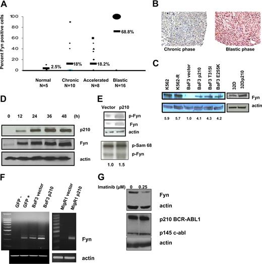 Figure 1. Fyn is up-regulated in chronic-phase CML and in BCR-ABL1–expressing cells. (A) Fyn protein expression is increased in blast-crisis CML. A tissue microarray containing bone marrow specimens from 10 chronic-phase patients, 8 accelerated-phase patients, and 16 blastic-phase patients was stained using an anti-Fyn–directed antibody as described in detail in Document S1. The percentage of Fyn-positive cells in each sample was counted and is depicted graphically. Eleven of 16 bone marrow specimens from blast crisis CML patients were 100% positive for Fyn. Numeric percentages next to the horizontal bars refer to average percentage of Fyn-positive cells in each group. (B) Fyn expression increases from chronic phase to blast crisis in the same patient. Paired bone marrow specimens from a patient who progressed from chronic phase to blastic myeloid blast crisis were acquired and stained for Fyn as described in Document S1. Images were acquired on a Nikon Microphot FXA microscope and 20×/0.75 numeric aperture objective lens (total magnification 200×; Nikon Instruments, Melville, NY), with an Olympus DP70 camera (Olympus America, Melville, NY) running DP controller software v.1.2.1.108 (Olympus). Images were processed with Adobe Photoshop CS v.8.0.1 (Adobe Systems, San Jose, CA). (C) Fyn protein levels are increased in BCR-ABL1–expressing cells. Fyn protein was assessed by Western blotting in K562 cells that are imatinib sensitive (lane 1) or imatinib resistant (lane 2), in BaF3 cells transduced with vector (lane 3), wild-type BCR-ABL1 (lane 4), or imatinib-resistant mutant BCR-ABL1 (lanes 5,6) and in parental 32D cells or 32D cells stably transfected with p210 BCR-ABL1. The same membrane was reprobed with antiactin antibody, and the ratio of Fyn/actin protein expression was calculated by densitometry. Numeric values listed below the bands represent a ratio of Fyn protein expression to actin protein expression and are normalized relative to Fyn levels in the BaF3 vector cells, which contain the lowest level of Fyn. Results shown were reproduced in 3 independent experiments. (D) Fyn protein is up-regulated in TonB cells transfected with a tetracycline-inducible BCR-ABL1 expression vector. Western blotting for p210 BCR-ABL1 (top panel) and Fyn (middle panel) in TonB cells transfected with an inducible expression vector after gene induction with 1 μg/mL doxycycline for 12 hours, 24 hours, 36 hours, or 48 hours. Actin protein levels (bottom panel) indicate equal loading. (E) Fyn kinase activity is increased in BCR-ABL1–expressing cells. (Top panel) Immunoprecipitation of Fyn and subsequent Western blotting with a phospho-Src antibody (labeled p-Fyn) or with Fyn antibody (labeled Fyn) shows increased expression of both in BCR-ABL1–expressing cells. Actin was probed in total cell lysates prior to immunoprecipitation. (Bottom panel) Kinase assay for Fyn was conducted in BaF3 vector and BaF3 p210 cells as described in Document S1 using Sam 68 as the substrate. A band corresponding to autophosphorylation of Fyn is also highlighted. Numeric values listed below the bands represent the densitometric analysis of the band corresponding to phosphorylated Sam 68 normalized relative to levels in the BaF3 vector cells (assigned a value of 1). (F) Fyn mRNA is up-regulated in an animal model for CML. Fyn mRNA levels were examined using Fyn-specific primers in cells sorted from a recipient mouse and transplanted with bone marrow from a donor mouse's stem cells transduced with MigR1-GFP-BCR-ABL1. Fyn mRNA was qualitatively measured by RT-PCR in GFP-sorted cells (indicating successful transduction) in the left panel. Also in the left panel, as a positive control for Fyn mRNA expression, BaF3 vector and BaF3 p210 cells were used to show that mRNA for Fyn was increased in BCR-ABL1–expressing cell lines. In the right panel, Fyn mRNA was compared in mice that received a transplant of mouse bone marrow infected with empty MigR1 vector or MigR1 p210-expressing vector. Actin was also amplified. (G) Inhibition of BCR-ABL1 decreases Fyn protein expression. K562 cells were treated with diluent or 0.25 μM imatinib for 24 hours, and levels of Fyn, p210 BCR-ABL1, p145 c-abl, and actin protein were measured by Western blotting. Results are representative of 3 independent experiments.