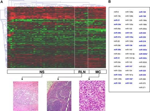 Figure 1. miRNA expression pattern in cHL. (A) Unsupervised hierarchic cluster analysis categorized 3 clusters corresponding to nodular sclerosis (NS), mixed cellularity (MC), and reactive lymph nodes (RLNs). A corresponding typical histology is shown. The data were presented as log10 of relative quantification normalized in regard to global median and relative to the 10 reactive lymph node median as calibration method. (B) A set of 55 miRNAs classified all samples into NS, MC, or RLN (PAM analysis). In blue, the 25 miRNAs comprising the miRNA expression signature capable of distinguishing between cHLs and RLNs.