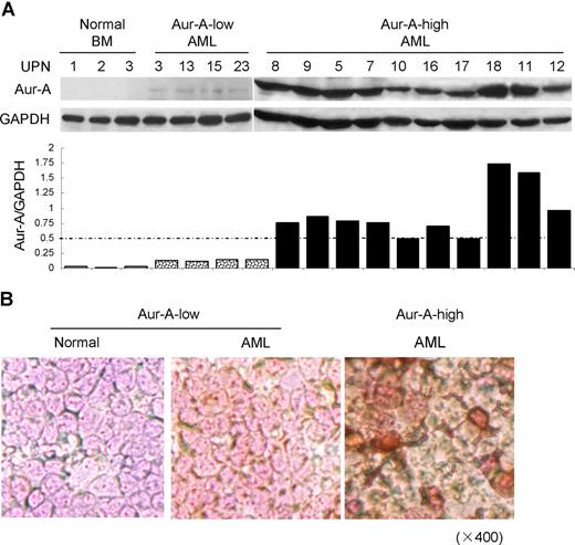 Figure 1. Aur-A is highly expressed in de novo primary AML bone marrow cells. (A) Endogenous expression of Aur-A in the representative AML samples and normal BMMCs (top). Primary leukemic blasts obtained from patients with AML were lysed and proteins were analyzed by Western blot analysis. GAPDH served as a loading control. The ratio of the intensity of the bands corresponded to Aur-A and GAPDH (bottom). AML samples were arbitrary divided into Aur-A-low and Aur-A-high cases, as described in “Statistical analysis.” UPN indicates unique patient number. (B) Bone marrow (BM) samples were collected from AML patients or normal donors and subjected to immunocytochemical staining with antibody against Aur-A. The Aur-A-high group exhibited strong staining of Aur-A (right), whereas the normal (left) and Aur-A-low group (middle) of AML samples showed weak staining (original magnification, ×400).