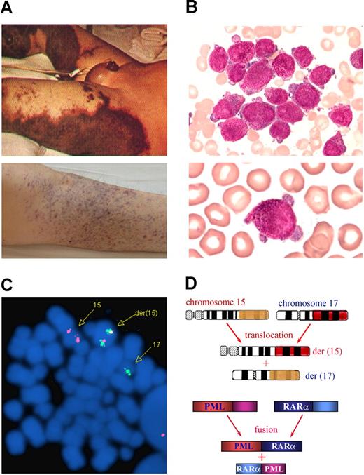 Figure 1. Clinical and molecular characteristics of APL. The 3 features of APL are (A) a severe bleeding tendency due to fibrinogenopenia and disseminated intravascular coagulation, (B) accumulation of abnormal promyelocytes in bone marrow (top panel) and peripheral blood (bottom panel), and chromosomal translocation t(15;17)(q22;q21) (C) with the resultant fusion transcripts between PML and RARα (D). (C) t(15;17) detected by fluorescence in situ hybridization using PML-RARα dual-color, dual-fusion translocation probes (Vysis, Downers Grove, IL). (D) Schematics representing the formation of 15;17 reciprocal chromosomal translocations (top panel) and fusion transcripts (bottom panel). Stains were analyzed using an Olympus BX51 research microscope equipped with a 100×/1.30 numeric aperture (NA) oil objective (Olympus, Tokyo, Japan). Images were processed using Adobe Photoshop CS (Adobe Systems, San Jose, CA). Original magnification, ×1000.