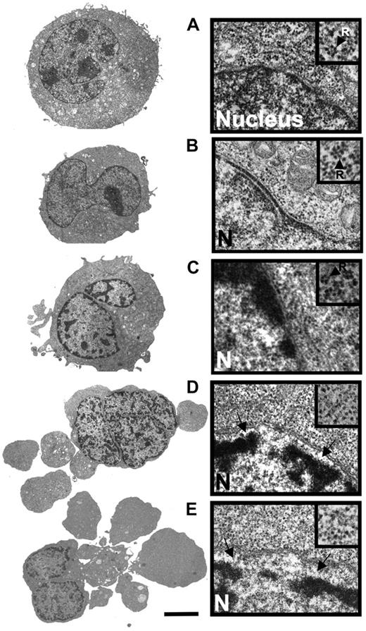 Figure 2. Comparison of the ultrastructural properties of HL60 cells treated with DNR alone and in combination with CHX. (A) Transmission electron microscopic overview (left) and detail showing part of nucleus and perinuclear region of control HL60 cell (incubated with vehicle for 5 hours). The inset (arrow; R) shows a polysomal rosette. (B) Cell treated with CHX (3.6 μmol/L) for 4 hours. (C) Cell treated with DNR (8 μmol/L) for 2.5 hours. Note beginning thickening of microvilli, perinuclear accumulation of condensed chromatin and polysomes (inset). (D) Cell treated for 2.5 hours with DNR (8 μmol/L) + CHX (3.6 μmol/L, added 1 hour after DNR). Note budding, separation of nuclear lamina from chromatin (arrows), and dispersal of polysomes (inset). (E) Cell treated with DNR (8 μmol/L) for 5 hours. Note similarity of features with cell in panel D. Panels A-E: scale bar: 5 μm for left subpanels, 0.3 μm for right subpanels, and 0.18 μm for right subpanel insets. The cells in panels A, B, and E are typical for the average cell in the population. The cells in panels C and D are representative of the 10% of cell population with most advanced apoptosis.