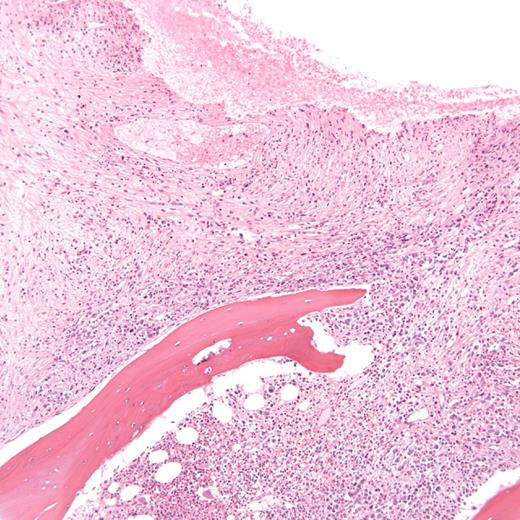Figure 1. Section of bone marrow trephine taken at diagnosis, demonstrating hyperplasia, areas of marked panmyelosis and fibrosis, and clusters of blasts.