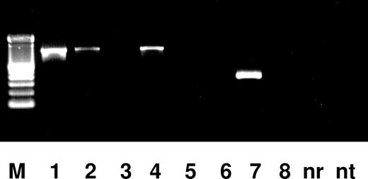Figure 2. Detection of the e6a2 transcript. M is a 100-bp ladder marker. A no RNA negative control (nr) and a no template (nt) negative control are shown. Amplification of the usual e1a2 transcript (PCR product of 389 bp) from the ALL-1 cell line, and absence of product from the HL-60 cell line are shown in lanes 7 and 8, respectively. The abnormal 1033-bp band seen at presentation in blood and bone marrow is demonstrated in lanes 1 and 2. Lane 3 reveals the absence of abnormal band from the remission bone marrow after initial therapy. A positive control sample is shown in lane 4.