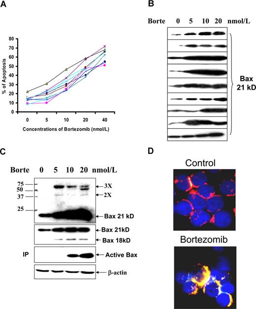 Figure 5. Bortezomib (Borte)-induced apoptosis and Bax activation in CLL cells. (A) Borte-induced apoptosis in 10 CLL samples. Fresh CLL cells were treated with different concentrations of Borte for 16 hours. Apoptotic cells were determined by the annexin V assay. (B) Borte-induced Bax protein accumulation in 9 cases of CLL patients. (C) Borte-induced Bax protein accumulation, oligomerization, and activation in 1 case of CLL patient. CLL cells were treated with Borte for 16 hours. Accumulation of Bax protein was determined by Western blotting using the anti-Bax antibody clone 2D2 at 1:1000 dilution. A total of 30 μg protein was loaded into each lane. Bax dimers and trimers are shown in the top panel blot indicated by 2× and 3×. For detection of conformationally changed Bax, the active form of Bax was immunoprecipitated (IP) by Bax 6A7 antibody and probed by Bax 2D2 antibody. (D) Bax translocation to mitochondria. CLL cells were treated with or without 20 nM Borte for 16 hours. Cells were stained with 100 nM MitoTracker for 15 minutes, washed 3 times, then fixed and permeabilized. Slides were stained with anti-Bax clone 3 antibody (1:20 dilution) for 1 hour and then stained with FITC-conjugated anti–mouse IgG (1:50 dilution) for 1 hour. Finally, slides were stained with 50 ng/mL DAPI. The red color indicates the mitochondrial location, and the yellow color represents the active Bax in the mitochondria.