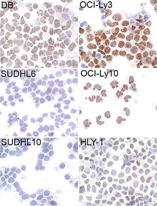 Figure 1. Immunoperoxidase labeling of DLBCL cell lines using the JC12 monoclonal antibody. The GCB-derived cell lines SUDHL6 and SUDHL10 are FOXP1 negative by immunohistochemistry, while the GCB-derived cell line DB, the ABC-like DLBCL cell lines OCI-Ly3 and OCI-Ly10, and the unsubtyped DLBCL cell line HLY-1 exhibit strong nuclear positivity. Cells were counterstained with hematoxylin Gill No. 2 (Sigma-Aldrich, St Louis, MO), mounted in Aquatex (VWR International, Poole, United Kingdom) and viewed using a bright field microscope (Axioskop; Zeiss, Welwyn Garden City, United Kingdom) fitted with a 40×/0.65 numerical aperture objective (Zeiss). The images were captured using a Micropublisher 5MP RTV camera (QImaging, Surrey, BC).