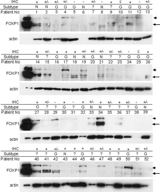 Figure 4. Western blotting of DLBCL biopsy samples using the JC12 monoclonal antibody. The JC12 immunohistochemistry (IHC) scoring for FOXP1 expression in routinely fixed tissue from each case was scored as + for strongly positive, +/− for weak/moderate, c for cytoplasmic, or − for negative, and the subtyping as non-GC (N) or GCB (G) was performed as described previously.9 The arrowhead indicates the position of the full-length FOXP1 protein, while the arrow indicates the smaller isoforms. The blots were reprobed with antiactin as a loading control.