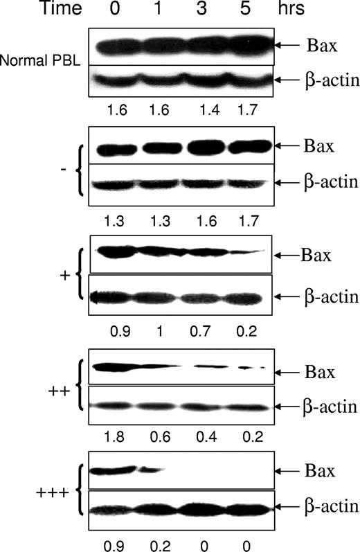 Figure 1. Bax degradation activity in primary CLL cells. The postnuclear supernatants were extracted from peripheral blood lymphocytes (PBL) from a healthy donor and CLL cells and incubated with the ubiquitin and ATP regeneration system for up to 5 hours. Twenty micrograms of protein were loaded in each lane for sodium dodecyl sulfate–polyacrylamide gel electrophoresis (SDS-PAGE). The Bax (clone 2D2) antibody was used in 1:1000 dilution and the β-actin antibody was used at 1:10 000 dilution. Numbers under each pair of blots are ratios of Bax/β-actin. Top panel shows results for a normal donor; lower 4 panels are cases of CLL.