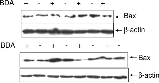 Figure 2. Bax protein levels in different CLL patients. Proteins were extracted from 15 different CLL samples using the lysis buffer. Twenty micrograms of protein were loaded in each lane for SDS-PAGE. The Bax (clone 2D2) antibody was used in 1:1000 dilution and the β-actin antibody was used at 1:10 000 dilution. BDA positive (+) and negative (−) cases are indicated above each lane.