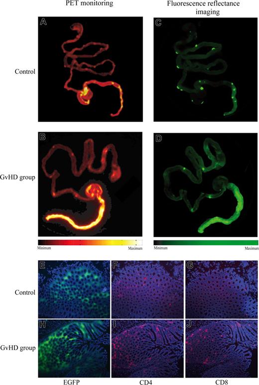 Figure 2. Intestinal FDG-PET signals correlated with tissue infiltration by EGFP+ donor lymphocytes. Lethally irradiated CB6F1 mice received transplants of BMCs alone (A,C) or with bone marrow and additional splenocytes (B,D) from C57BL/6-Tg(ACTB-EGFP) donors. At 1 hour after application of 50 MBq FDG on day 21 after transplantation, the whole gut was removed and scanned by PET (A,B). Subsequently, fluorescence reflectance imaging was performed to detect EGFP+ donor cells (C,D). Colocalized with intestinal FDG uptake, fluorescence imaging demonstrated an accumulation of EGFP+ donor cells in Peyer plaques and in the colon of mice with intestinal GVHD. Analyses of these colon specimens by fluorescence microscopy showed tissue infiltration by EGFP+ donor cells (E,H). Immunofluorescene staining revealed predominant CD4+ (F,I) and CD8+ (G,J) lymphocyte infiltration in EGFP+ areas. For simplification, spleen images were removed from the original PET and fluorescence images, as they were not relevant for intestinal GVHD. The results are representative of at least 3 independent experiments.